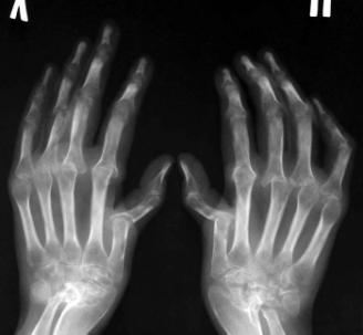 Рентгенограмма кистей рук