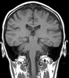 Томограмма (фас) головного мозга   (после обработки на компьютере)